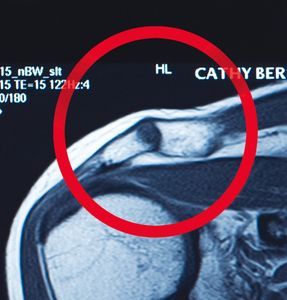 Cathy Rinder shoulder damage